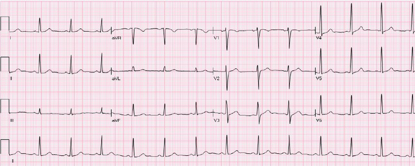 A clean scanned 12-lead ECG in the standard 4x4 layout: I aVR V1 V4 / II aVL V2 V5 / III aVF V3 V6, plus a lead-II rhythm strip
