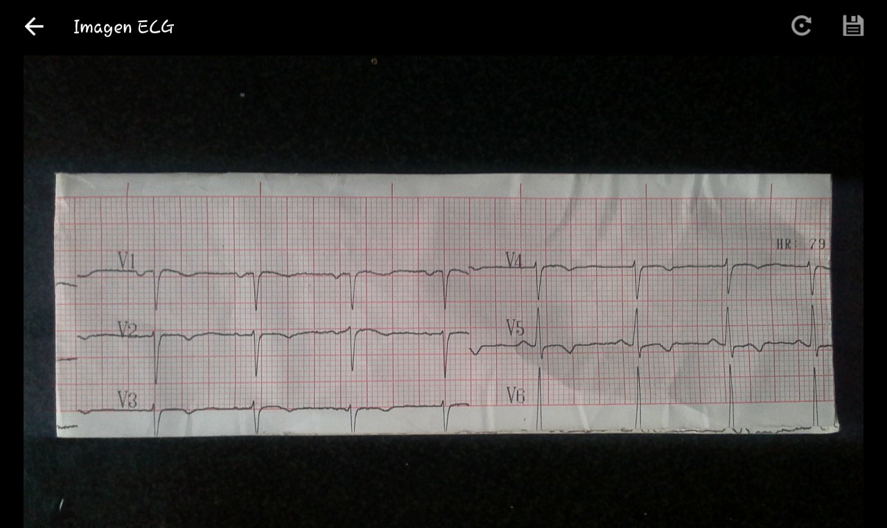 An Android app showing a captured photo of a printed ECG strip, precordial leads V1&ndash;V6, on a dark background