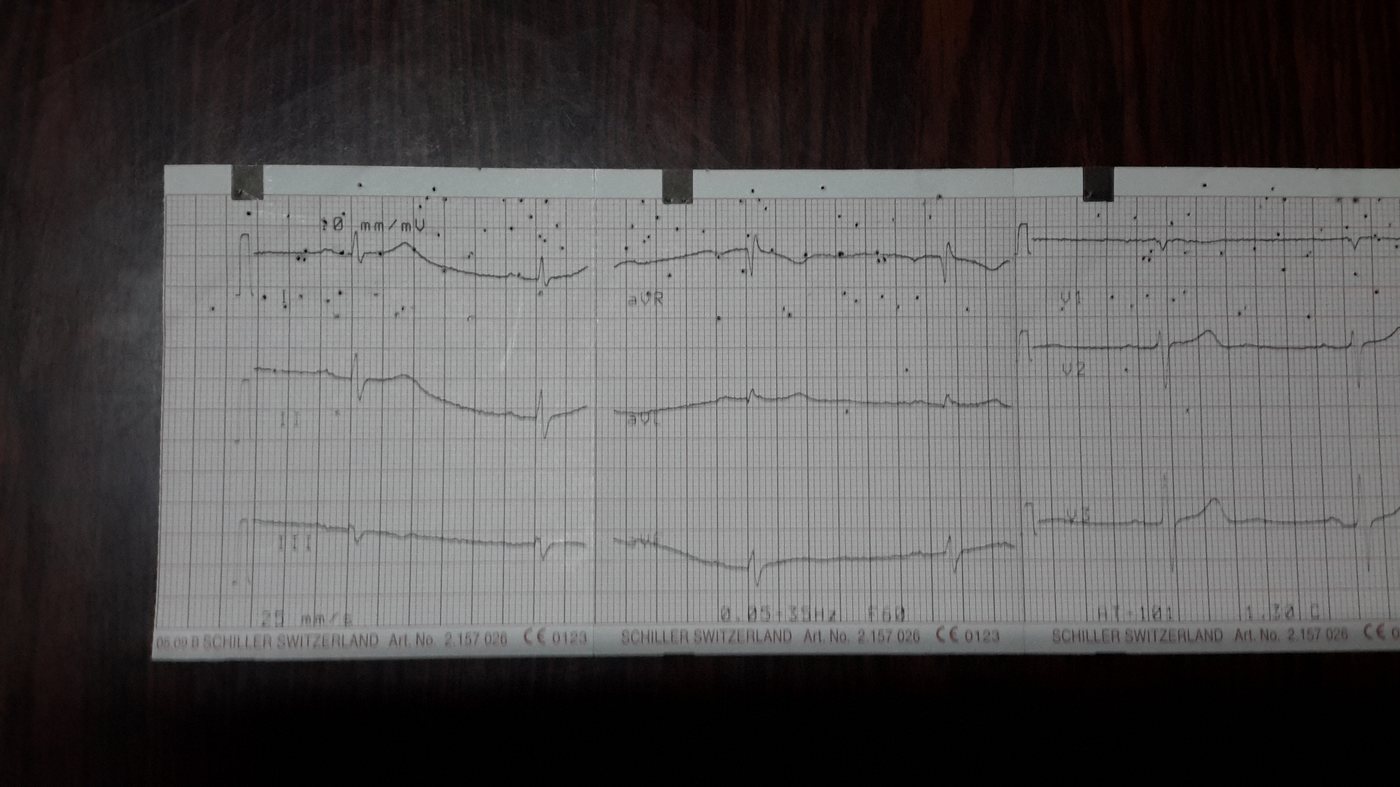 A real Schiller ECG paper strip photographed on a wooden table with a phone camera, showing the device's gain and filter settings printed along the strip