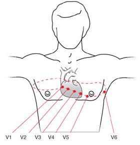 The six precordial chest leads V1 through V6 arranged in an arc around the heart