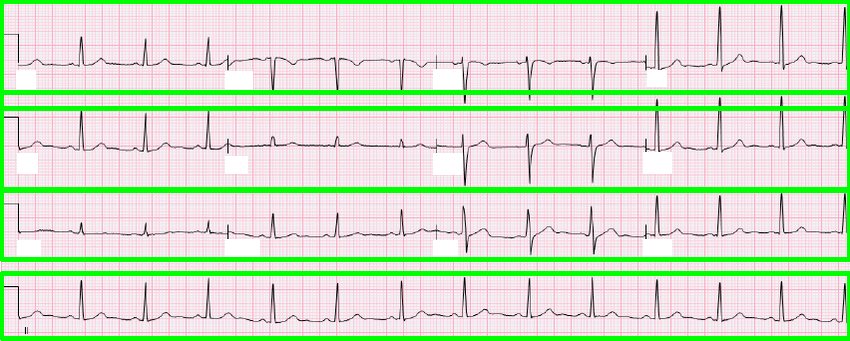 An ECG image with its four lead rows outlined in green boxes after successful row segmentation